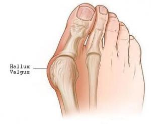 Img comment traiter les oignons aux pied sans chirurgie 138 300